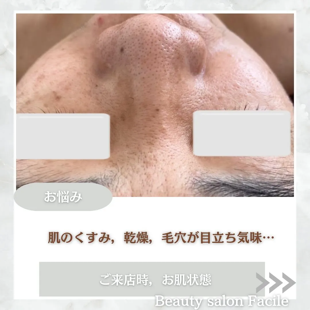 太田市にある頑固なニキビ専門店です✨️