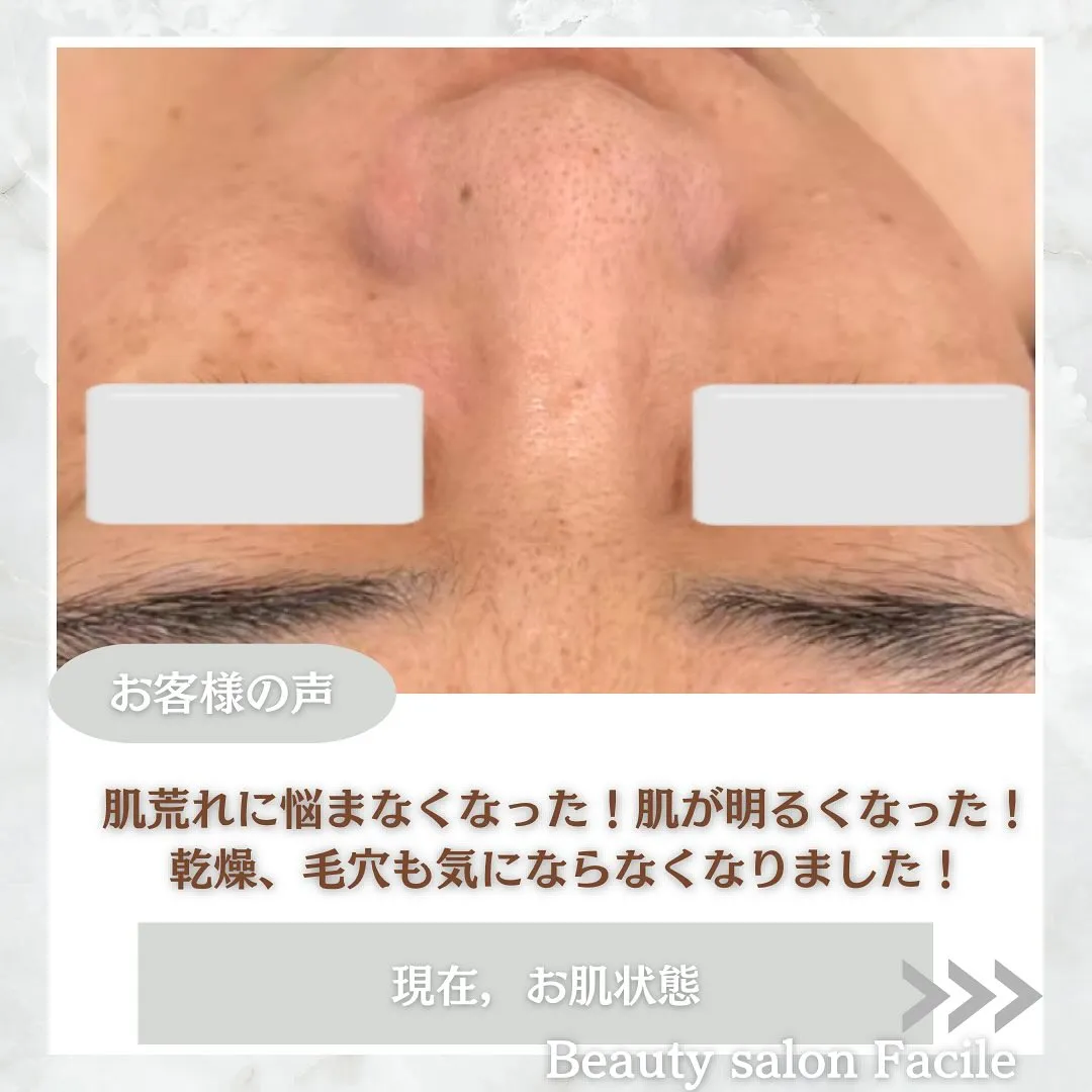 太田市にある頑固なニキビ専門店です✨️