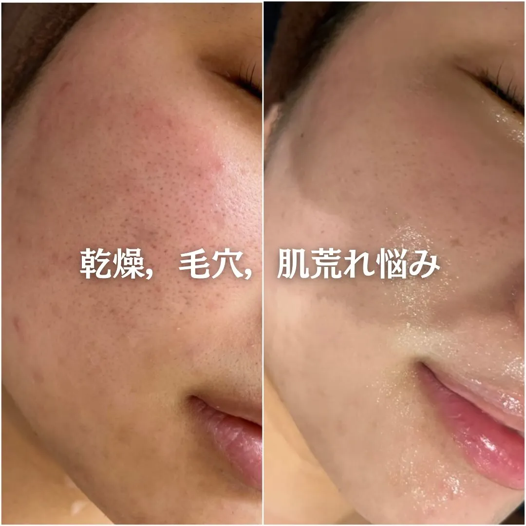 太田市にある頑固なニキビ専門店です✨️