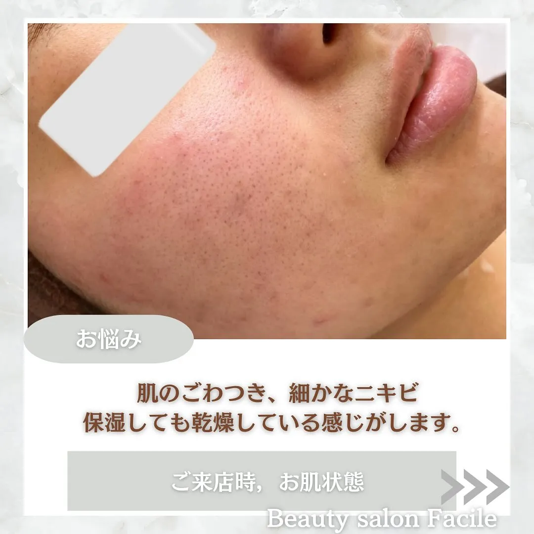 太田市にある頑固なニキビ専門店です✨️