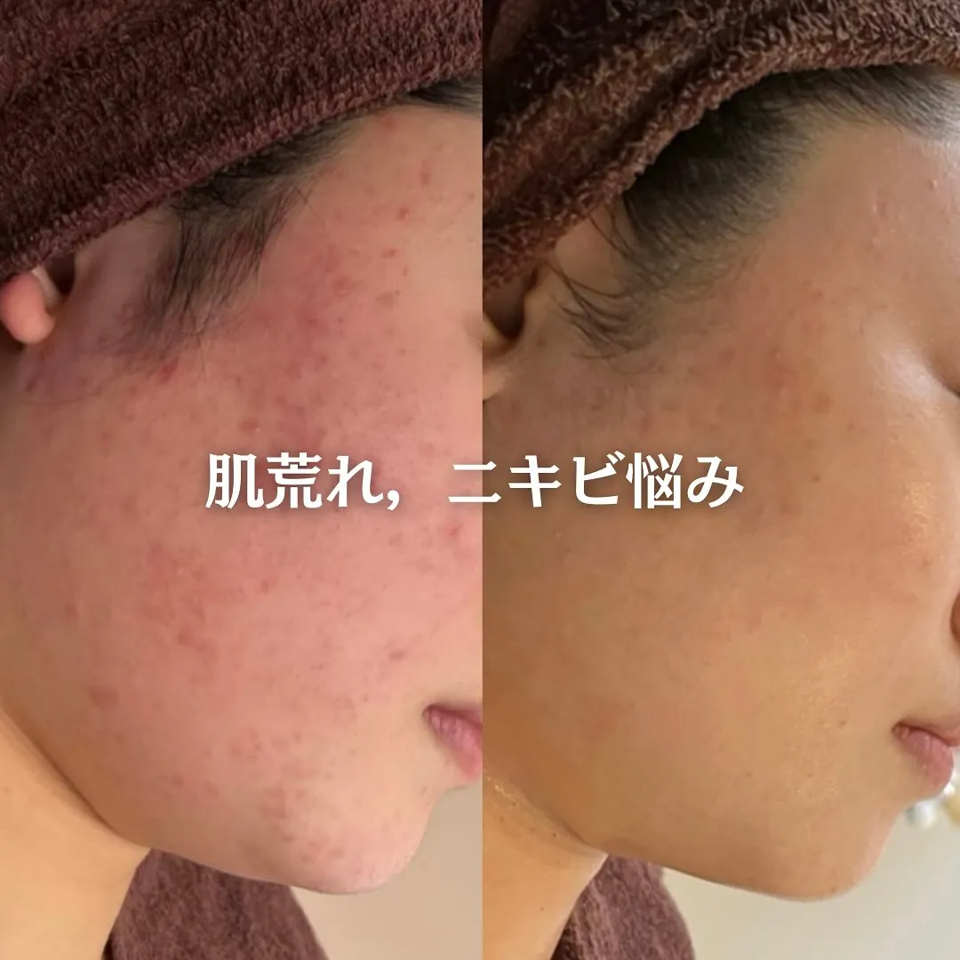 太田市にある頑固なニキビ専門店です✨️