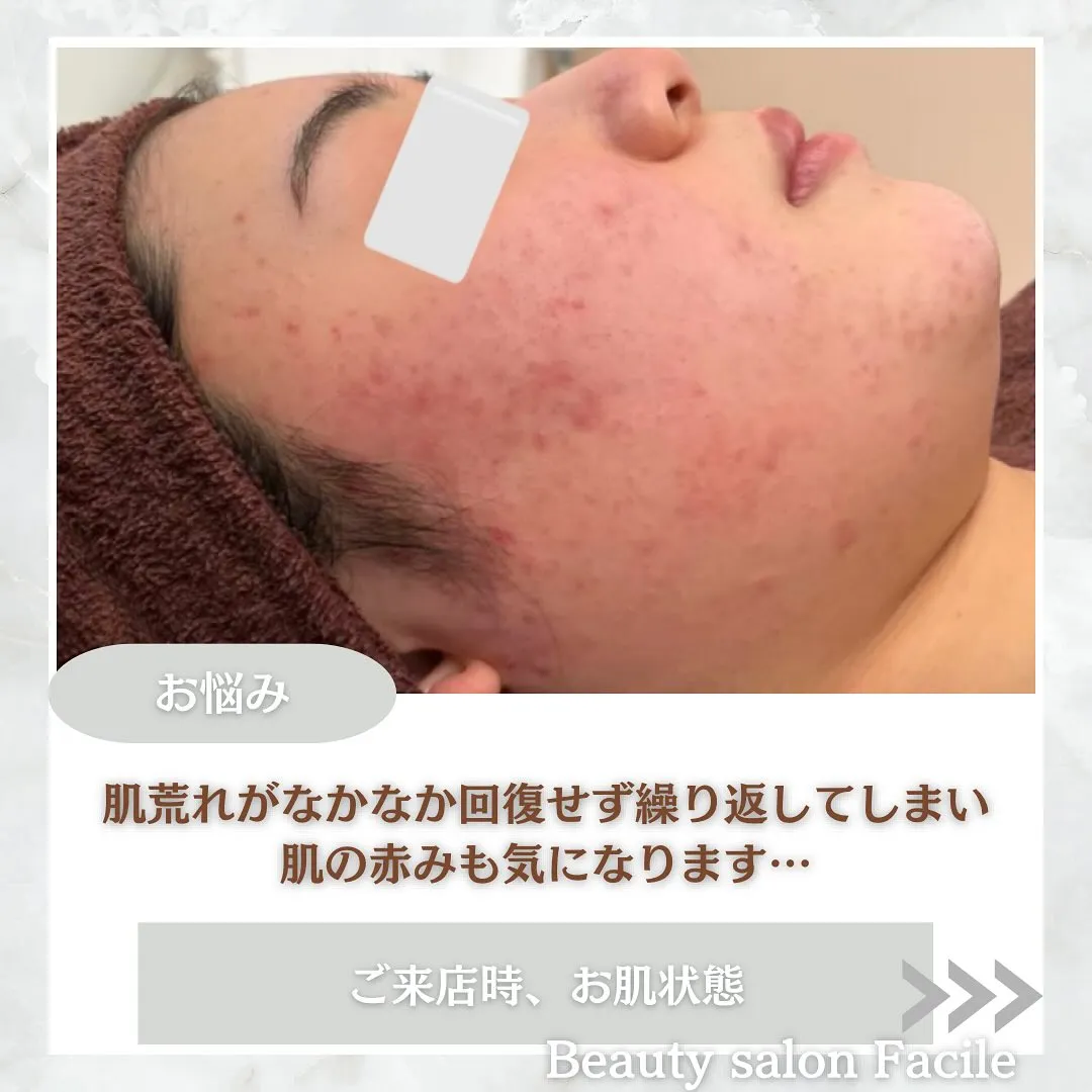 太田市にある頑固なニキビ専門店です✨️