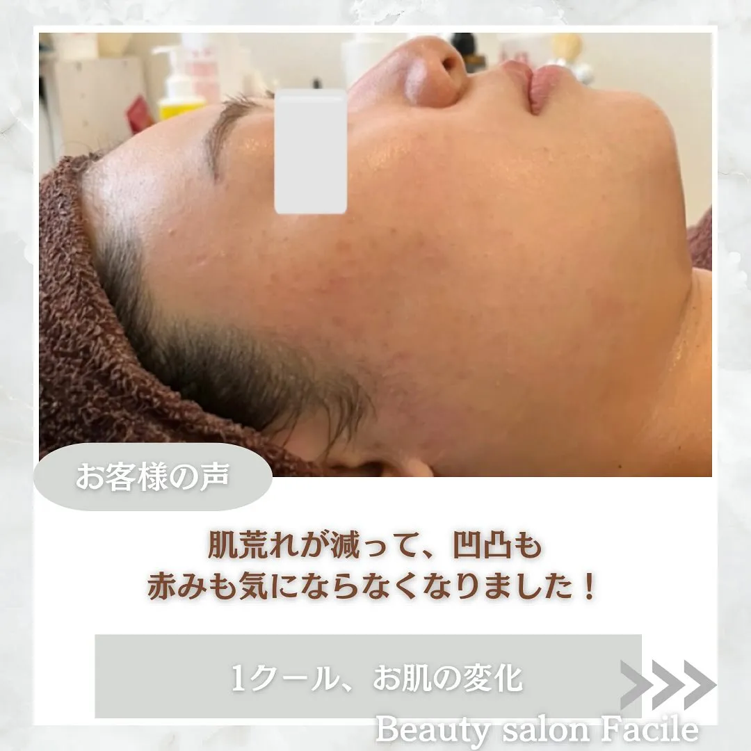 太田市にある頑固なニキビ専門店です✨️