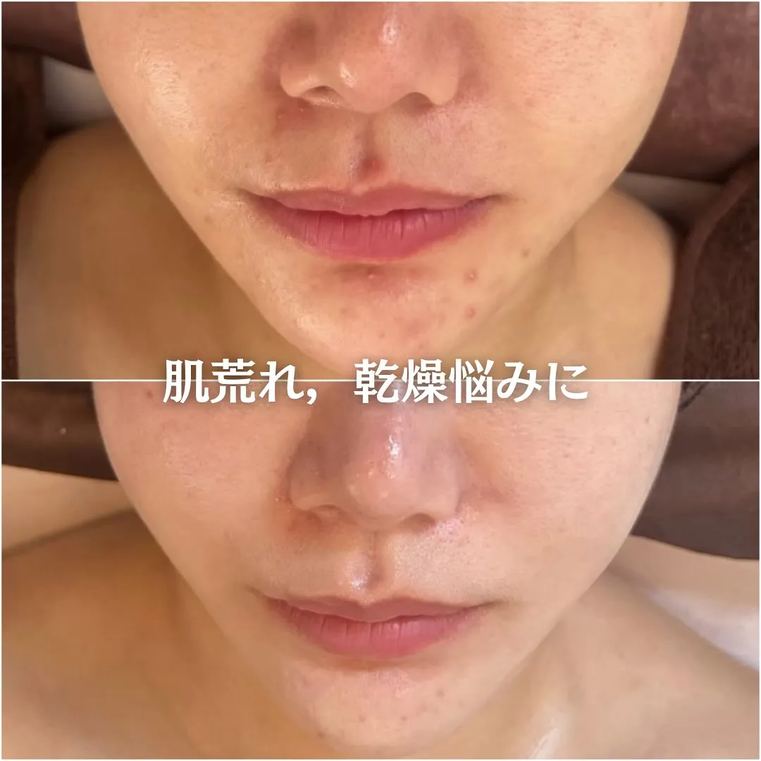 太田市にある頑固なニキビ専門店です✨️