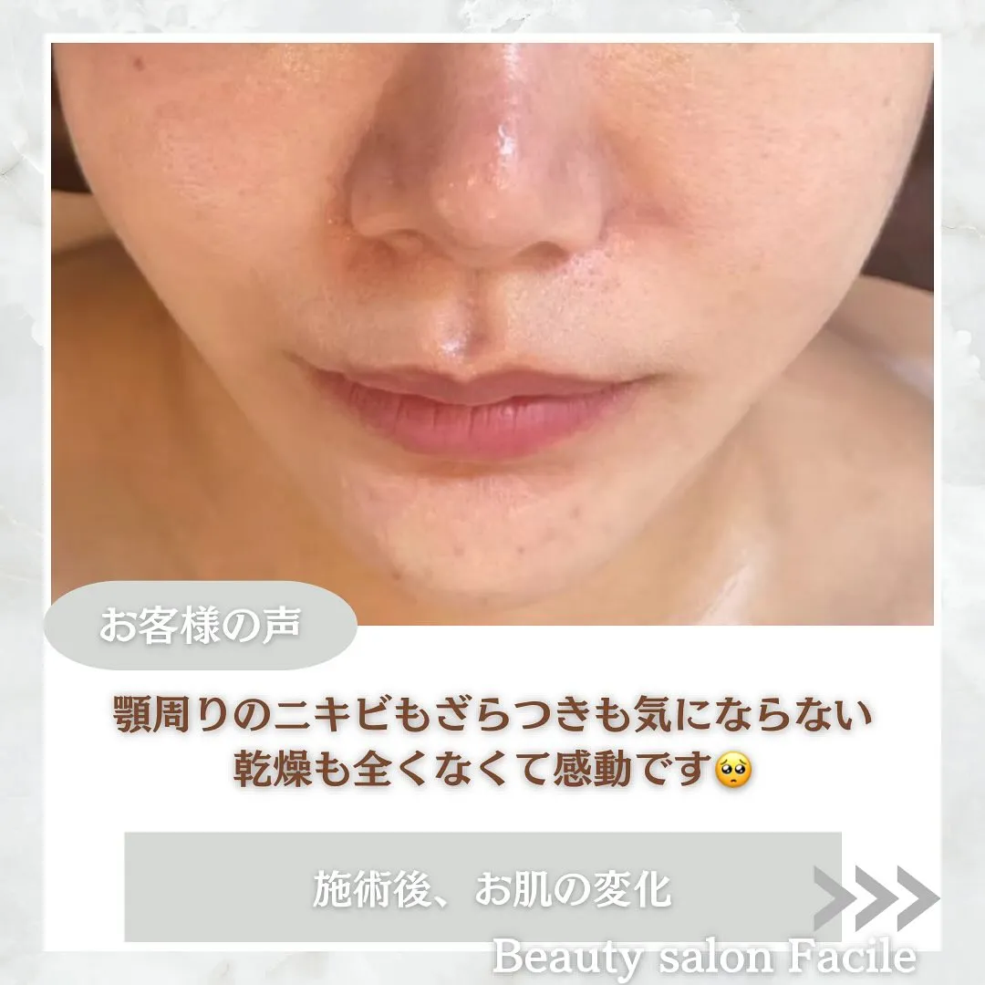 太田市にある頑固なニキビ専門店です✨️