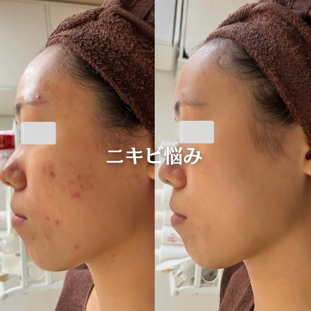 太田市にある頑固なニキビ専門店です✨