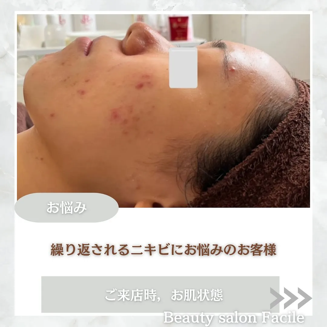 太田市にある頑固なニキビ専門店です✨