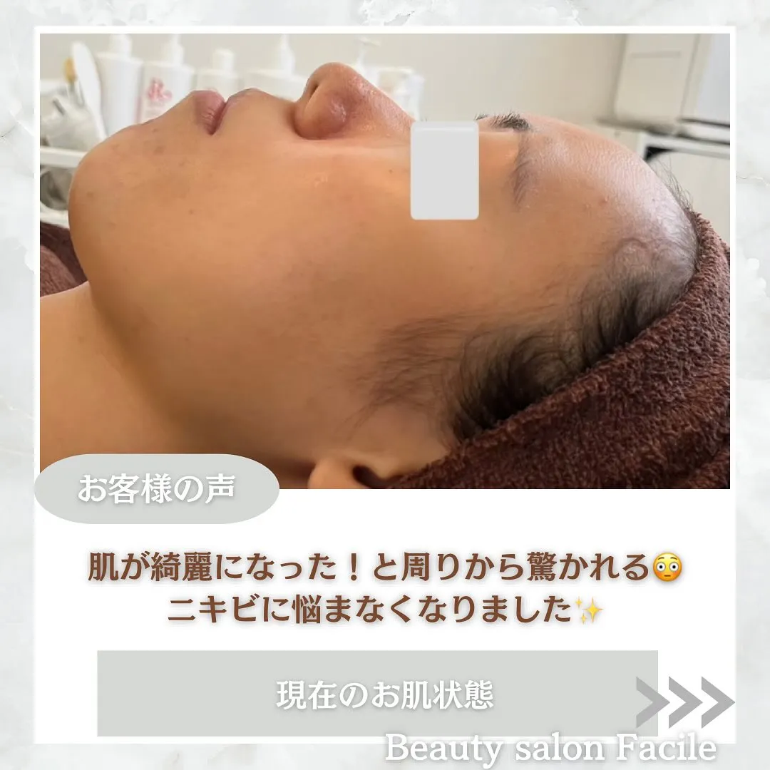 太田市にある頑固なニキビ専門店です✨