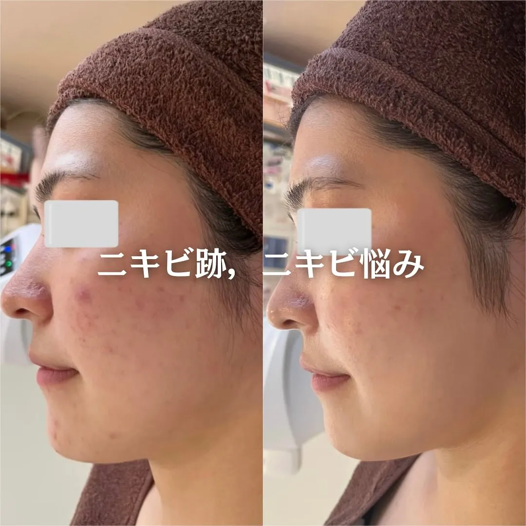 太田市にある頑固なニキビ専門店です✨️