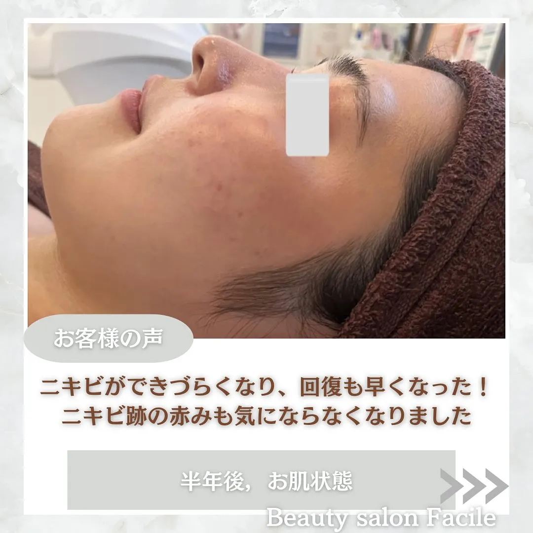 太田市にある頑固なニキビ専門店です✨️