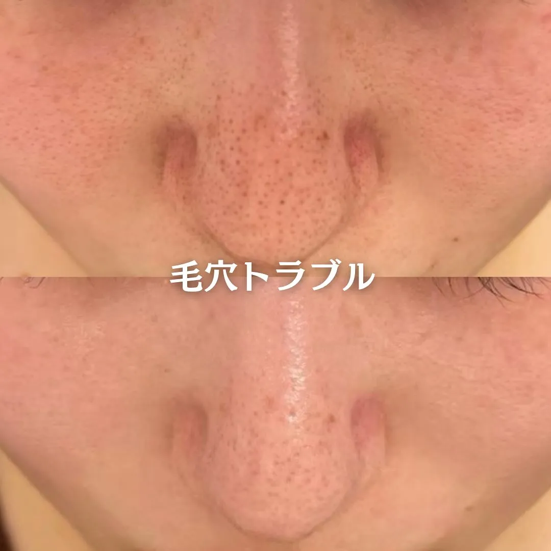 太田市にある頑固なニキビ専門店です✨️