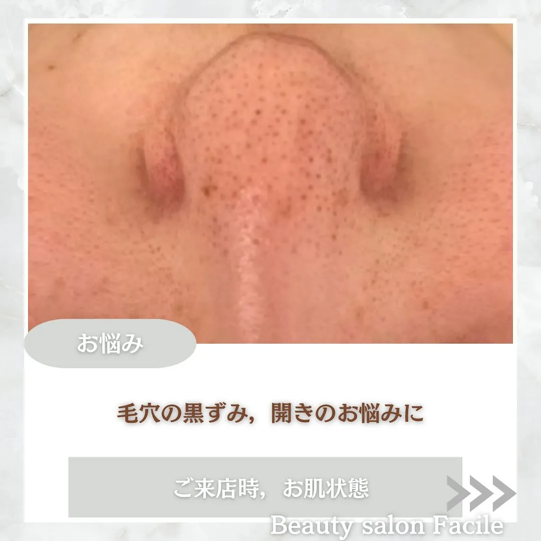 太田市にある頑固なニキビ専門店です✨️