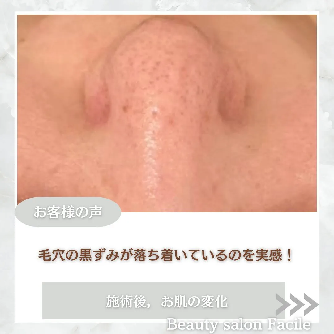 太田市にある頑固なニキビ専門店です✨️