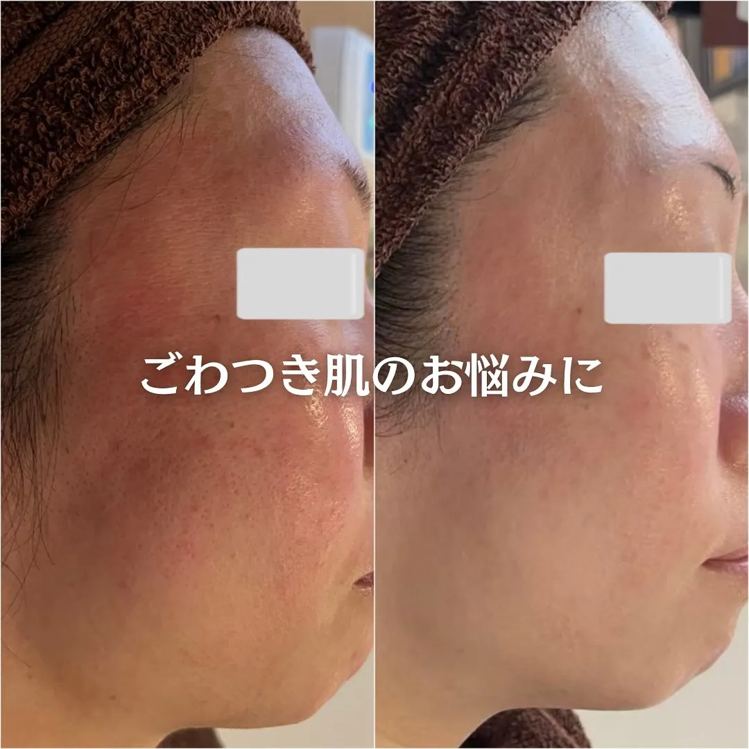 太田市にある頑固なニキビ専門店です✨️