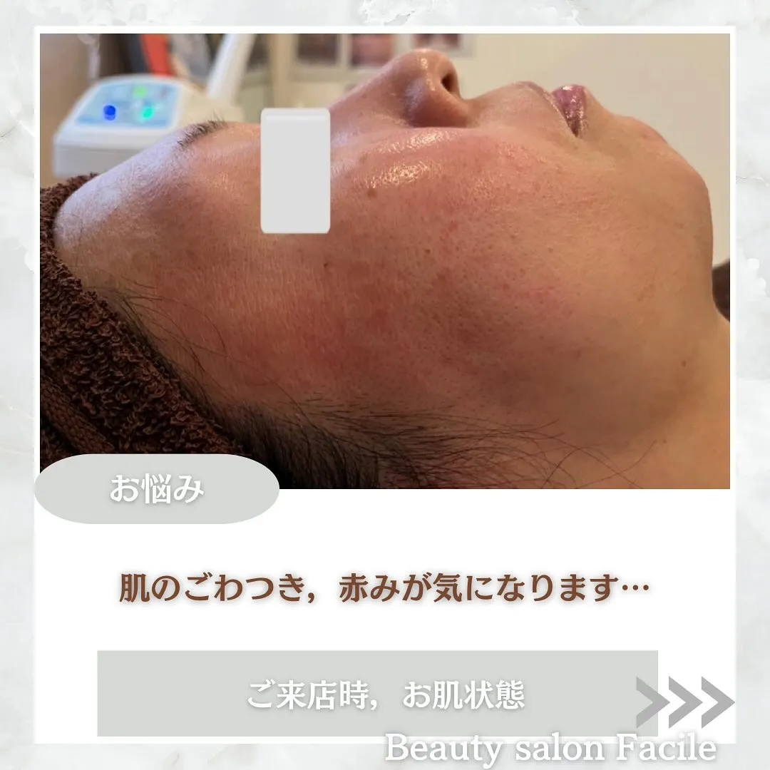 太田市にある頑固なニキビ専門店です✨️