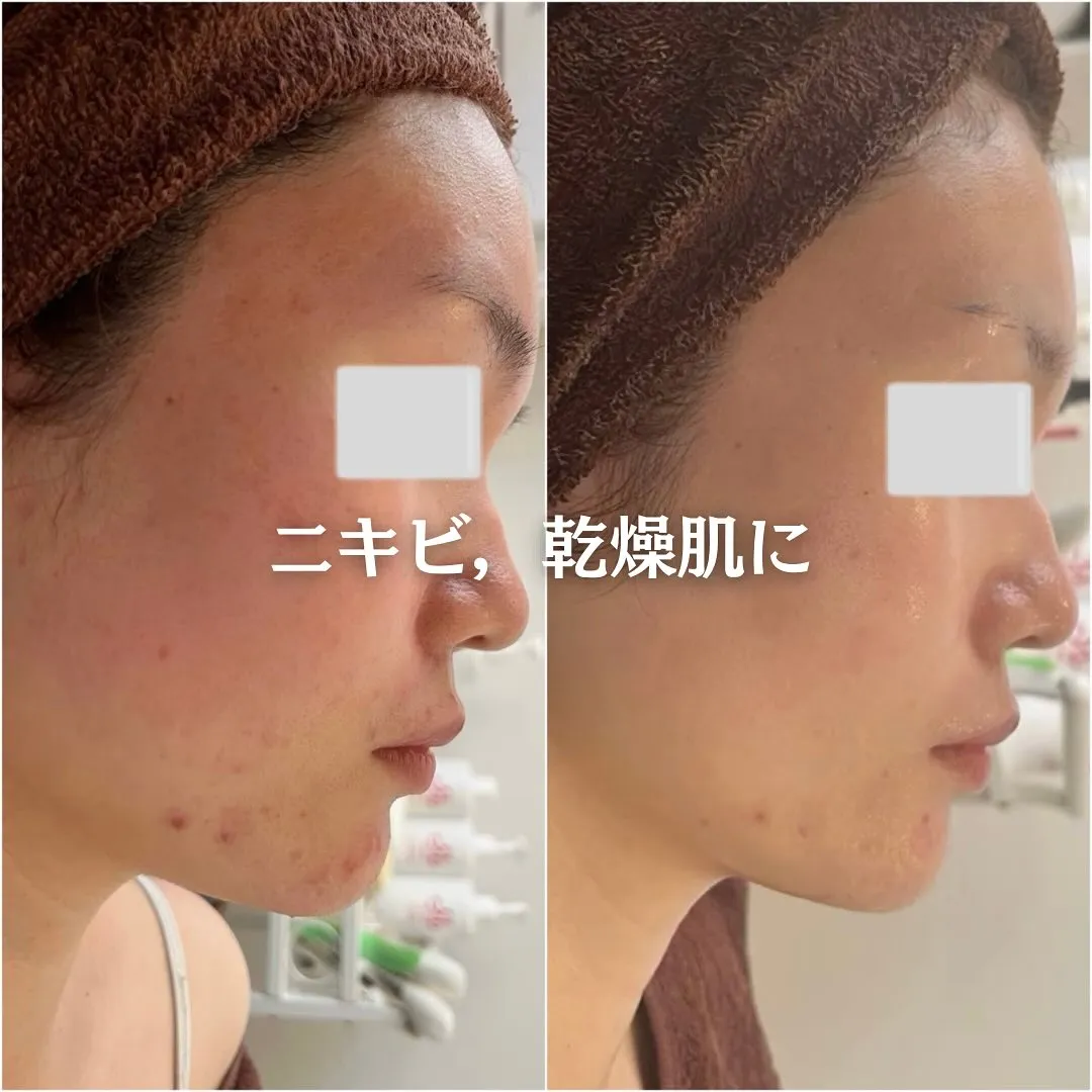 太田市にある頑固なニキビ専門店です✨️