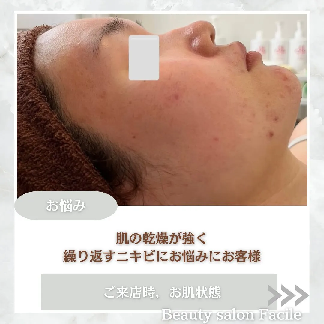 太田市にある頑固なニキビ専門店です✨️