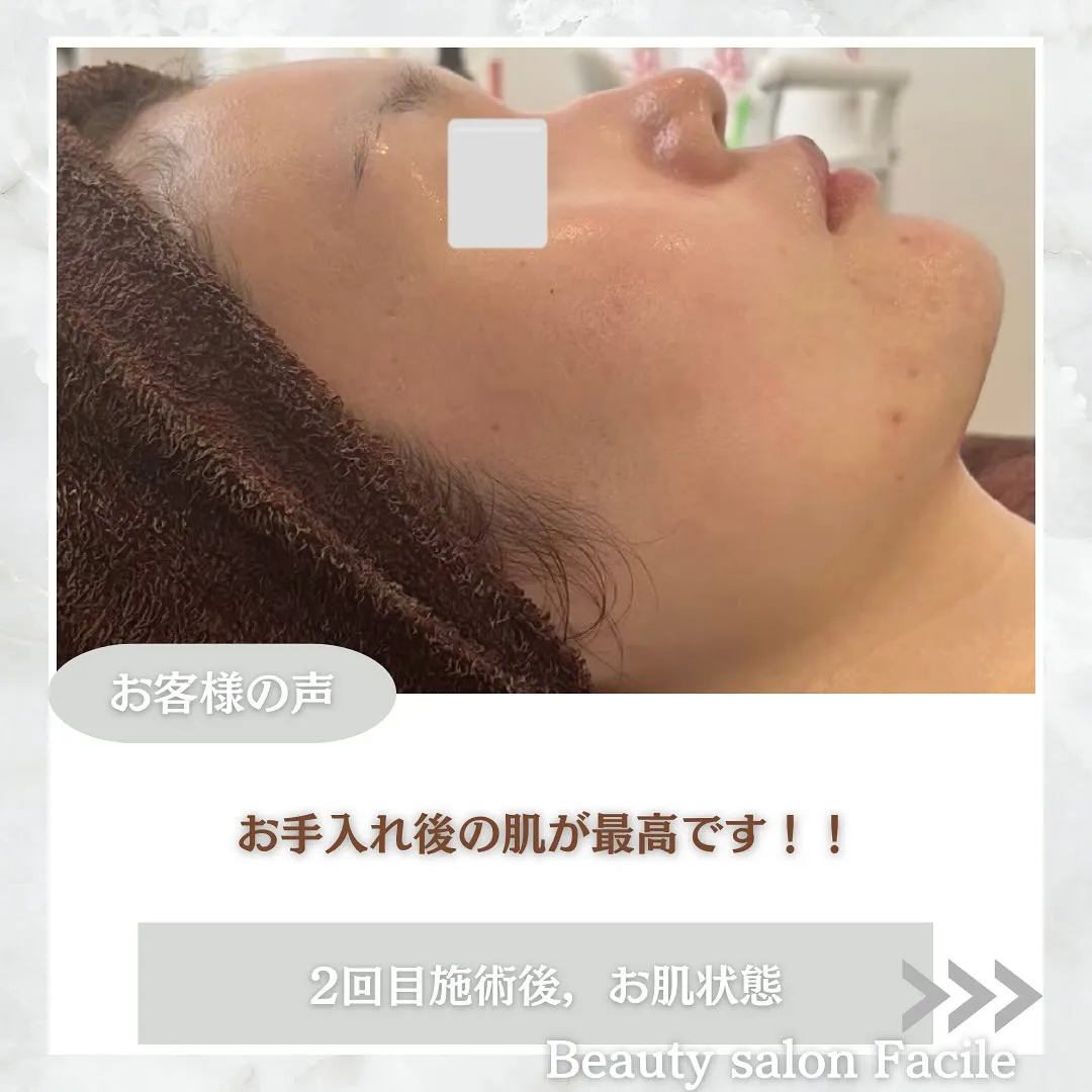 太田市にある頑固なニキビ専門店です✨️