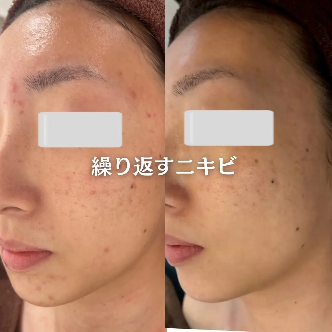 太田市にある頑固なニキビ専門店です✨️