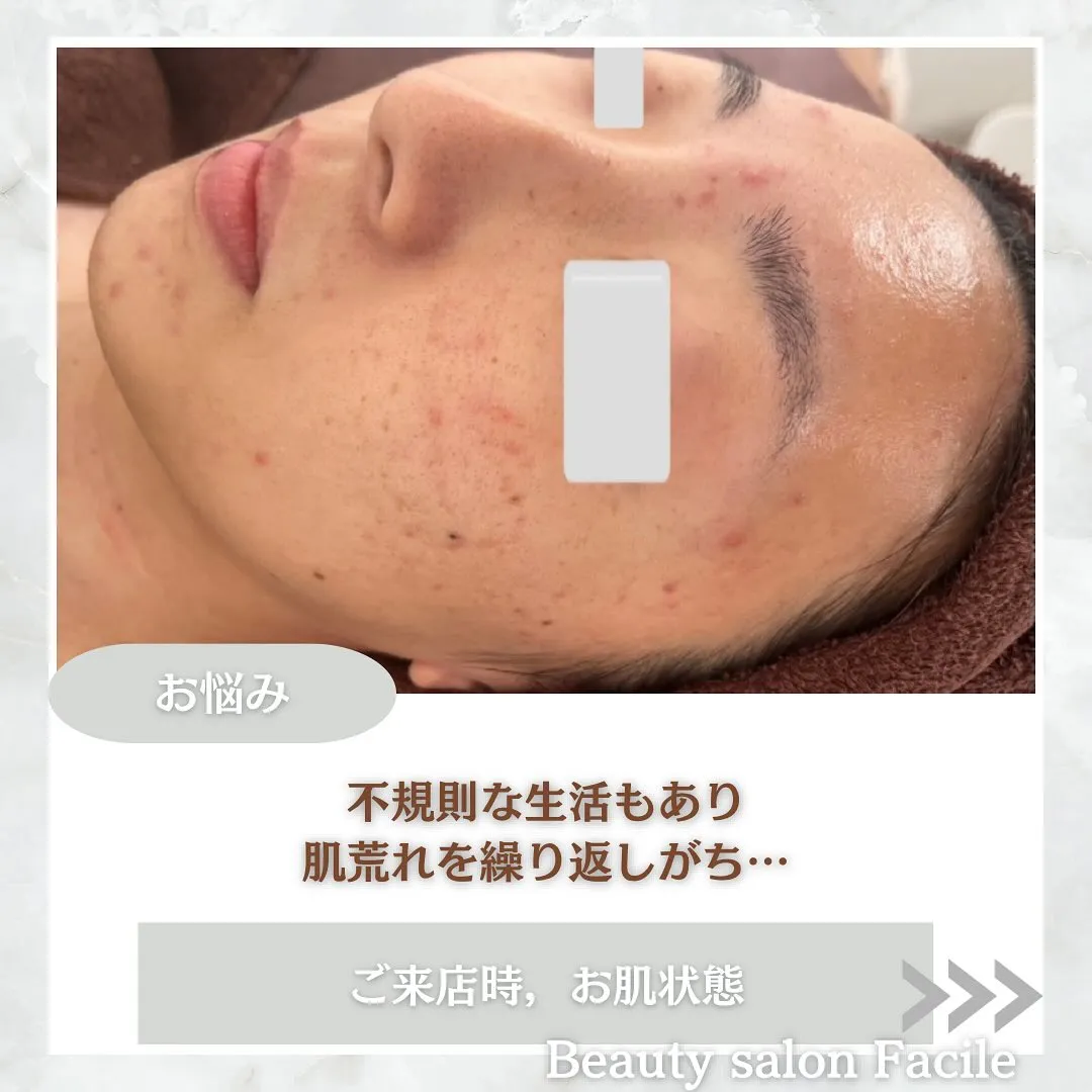 太田市にある頑固なニキビ専門店です✨️