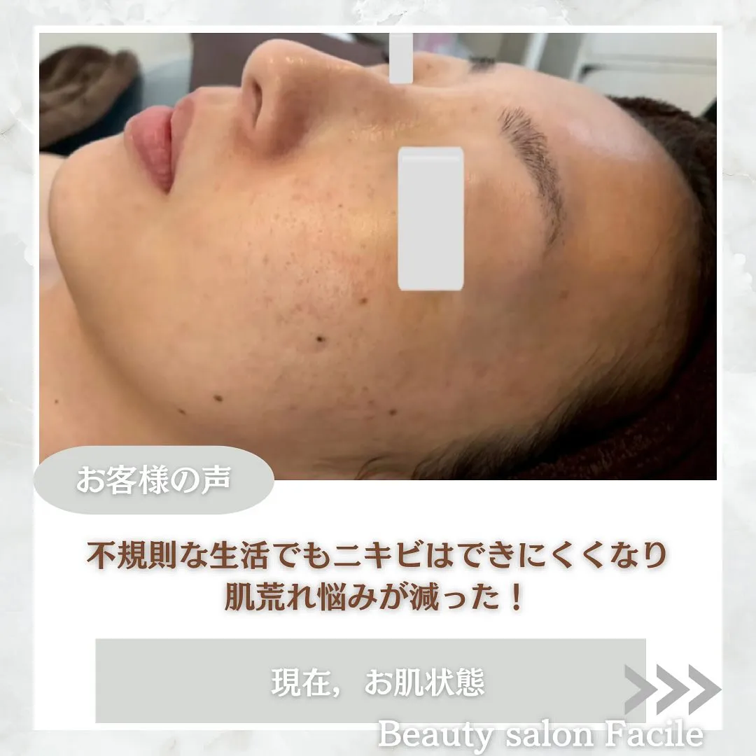 太田市にある頑固なニキビ専門店です✨️