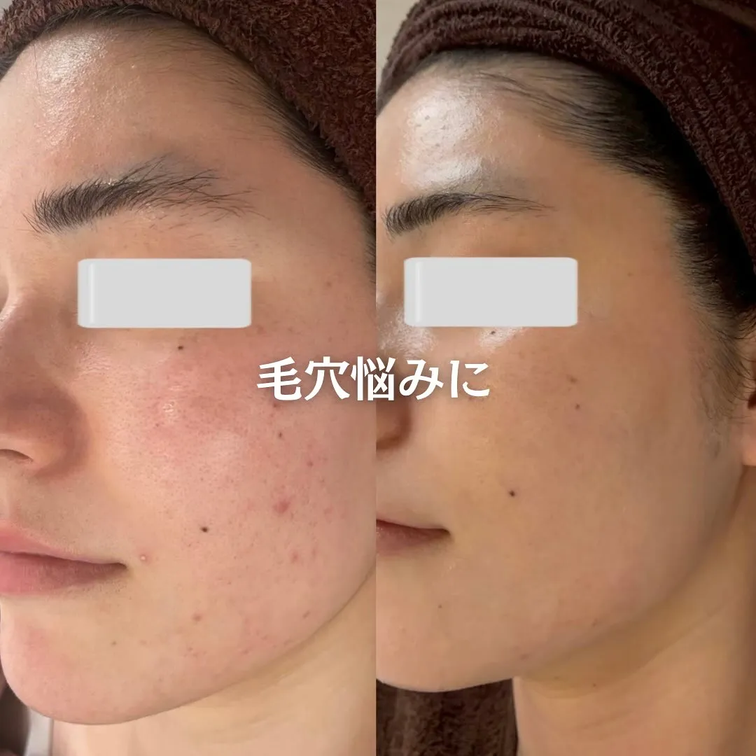 太田市にある頑固なニキビ専門店です✨️