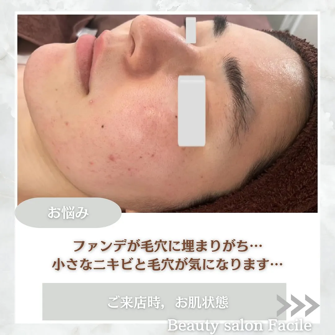 太田市にある頑固なニキビ専門店です✨️