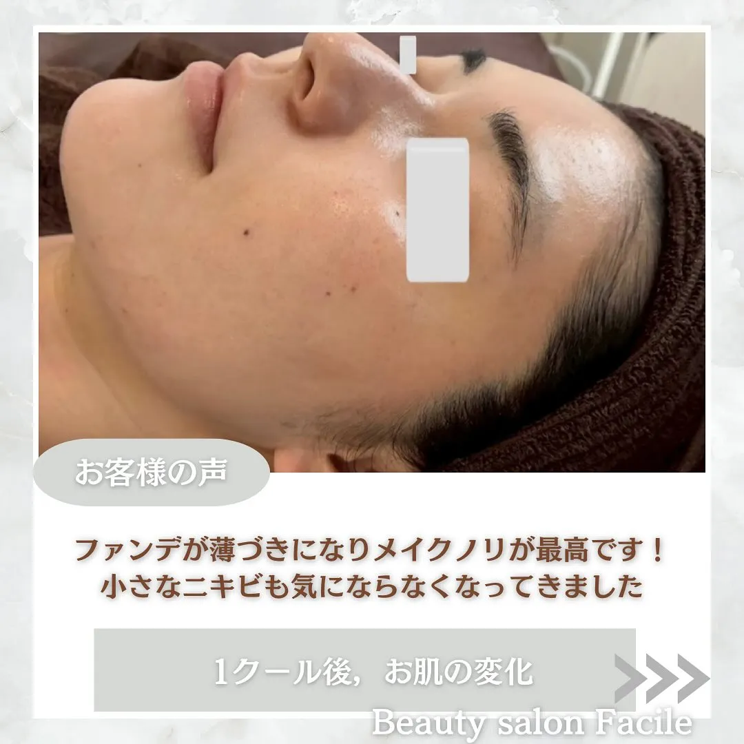 太田市にある頑固なニキビ専門店です✨️