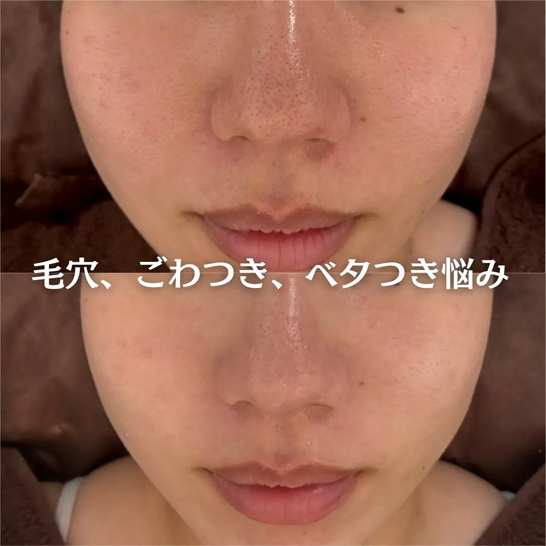 太田市にある頑固なニキビ専門店です✨️