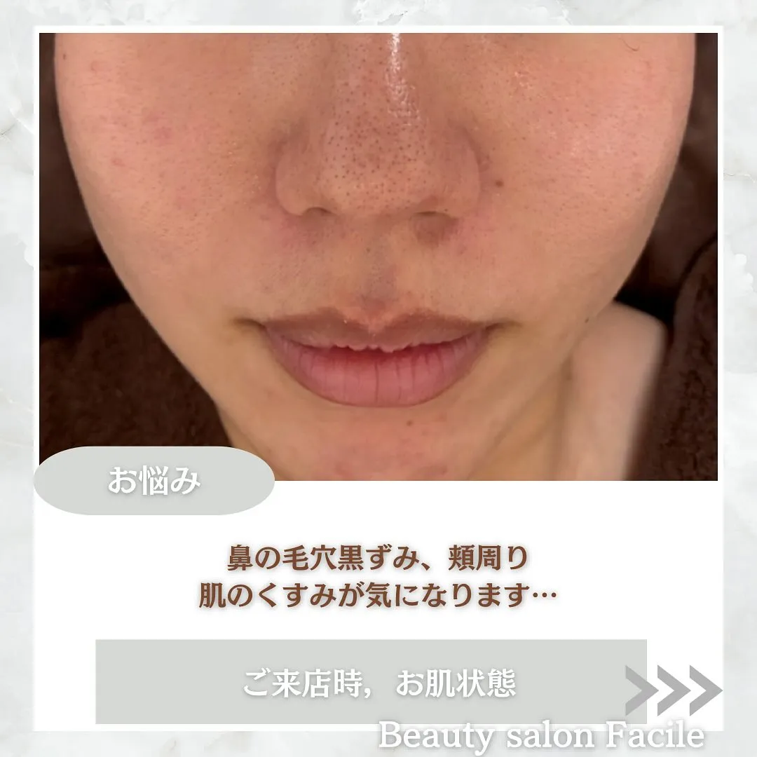 太田市にある頑固なニキビ専門店です✨️