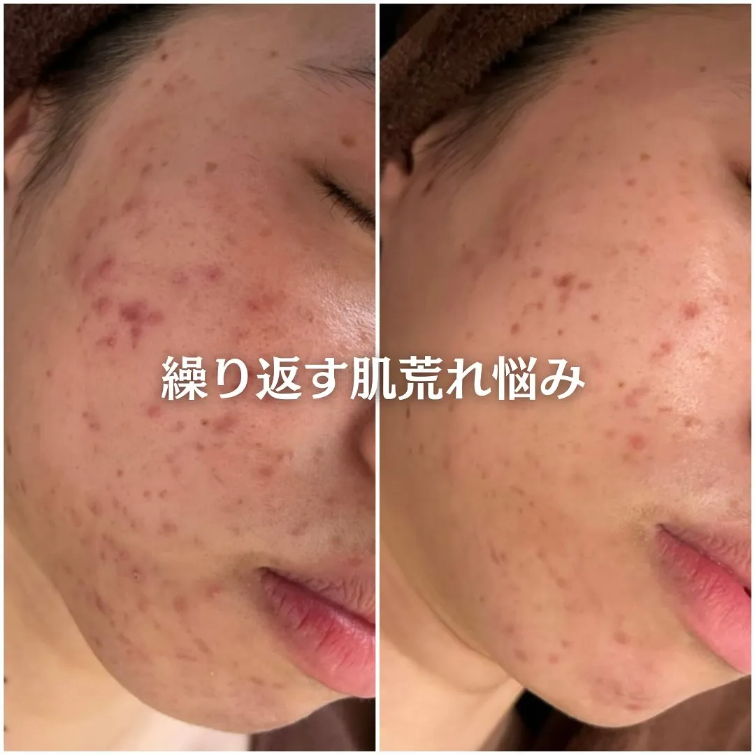 太田市にある頑固なニキビ専門店です✨️