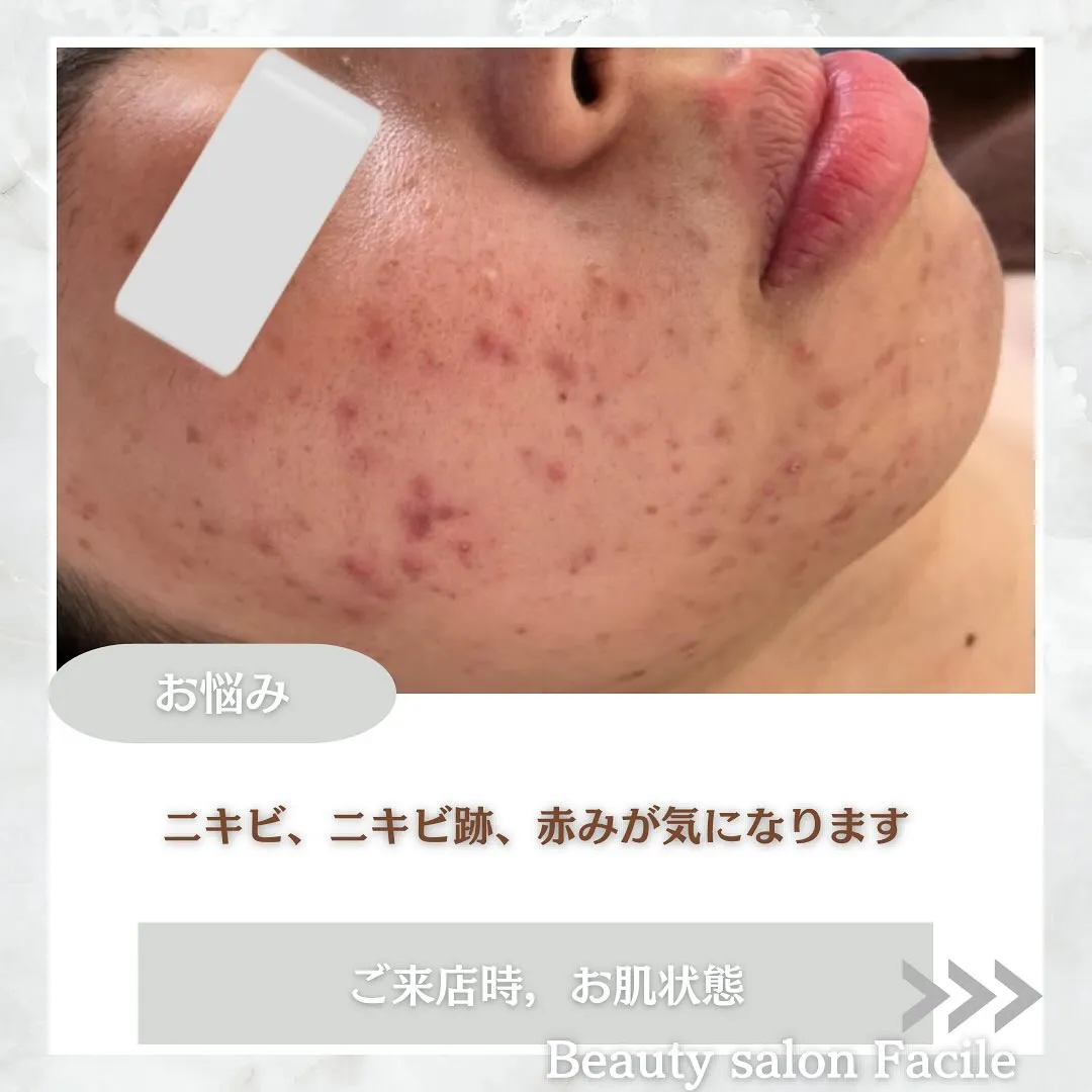 太田市にある頑固なニキビ専門店です✨️