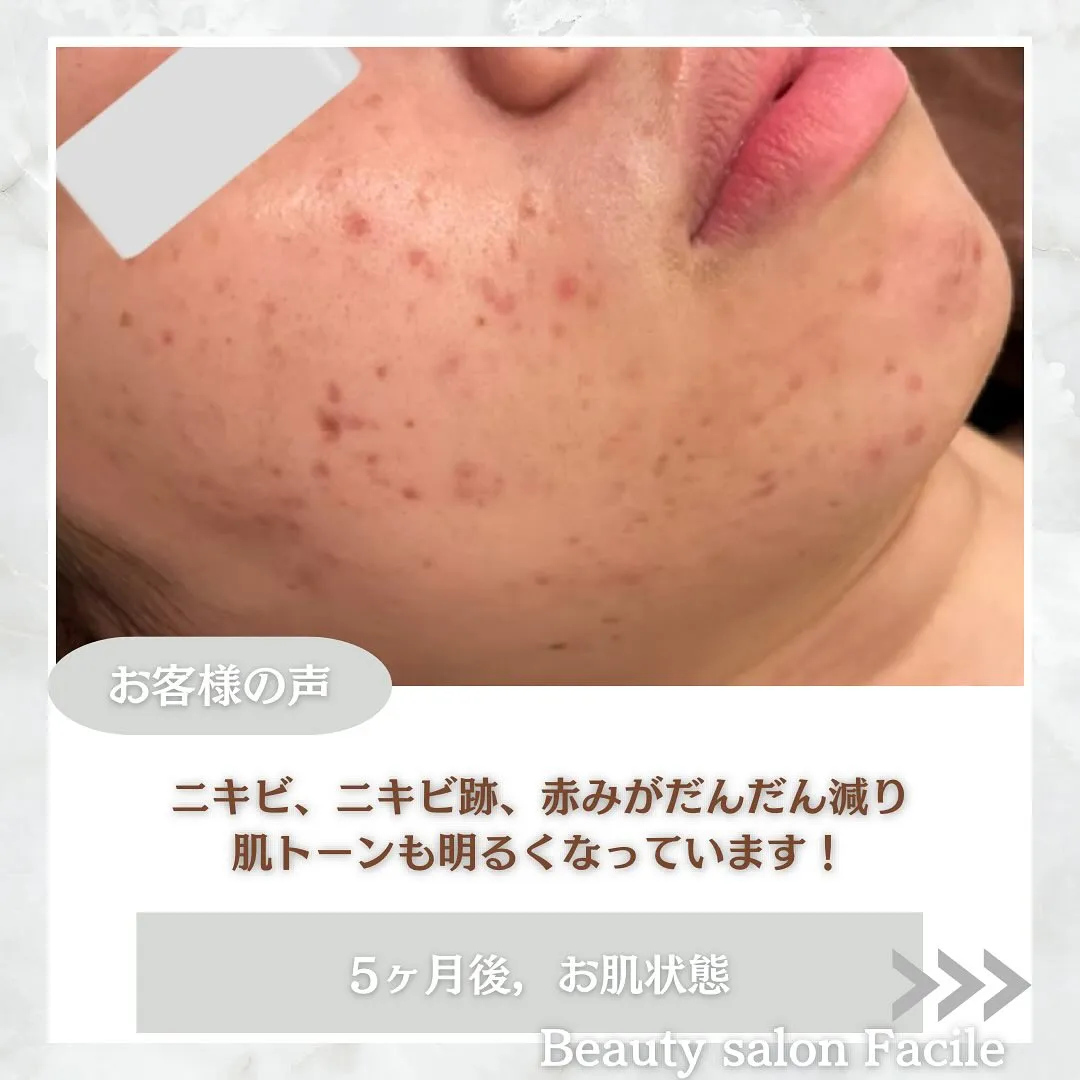 太田市にある頑固なニキビ専門店です✨️