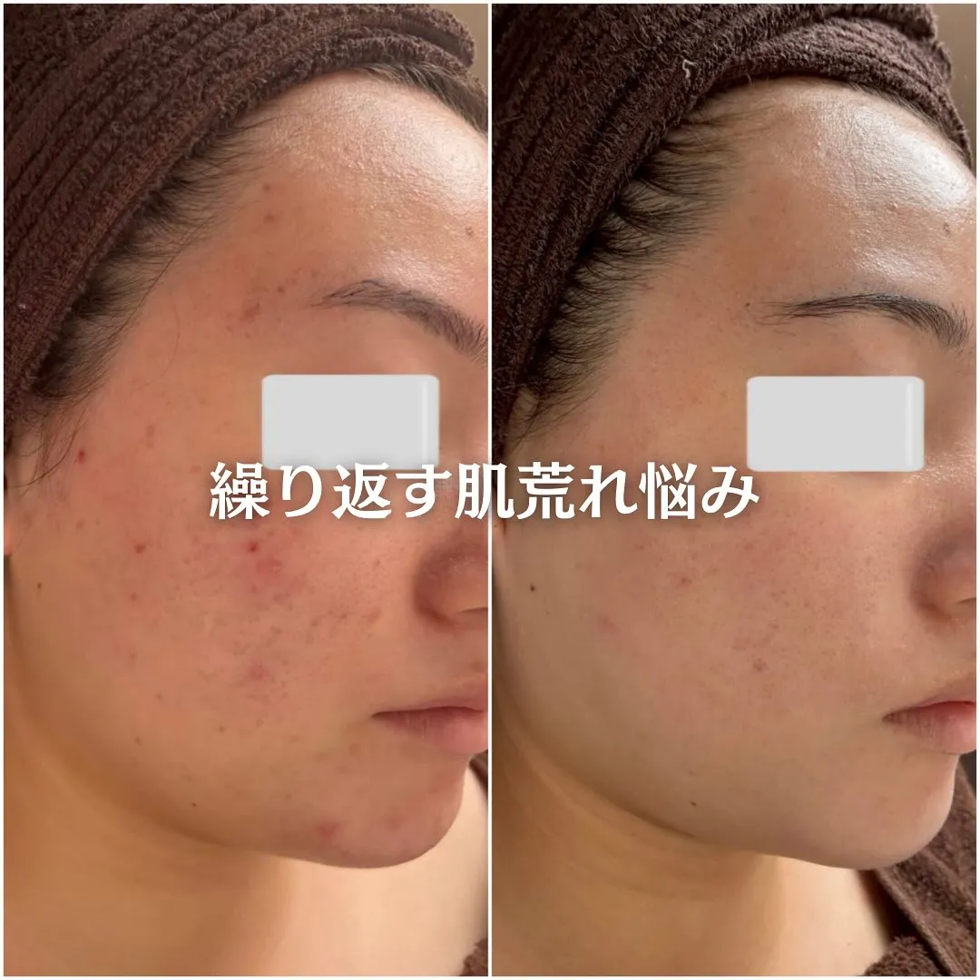 太田市にある頑固なニキビ専門店です✨️