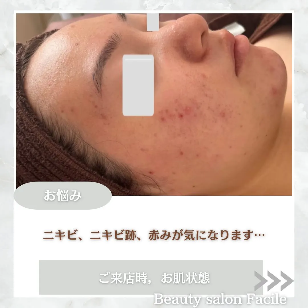 太田市にある頑固なニキビ専門店です✨️