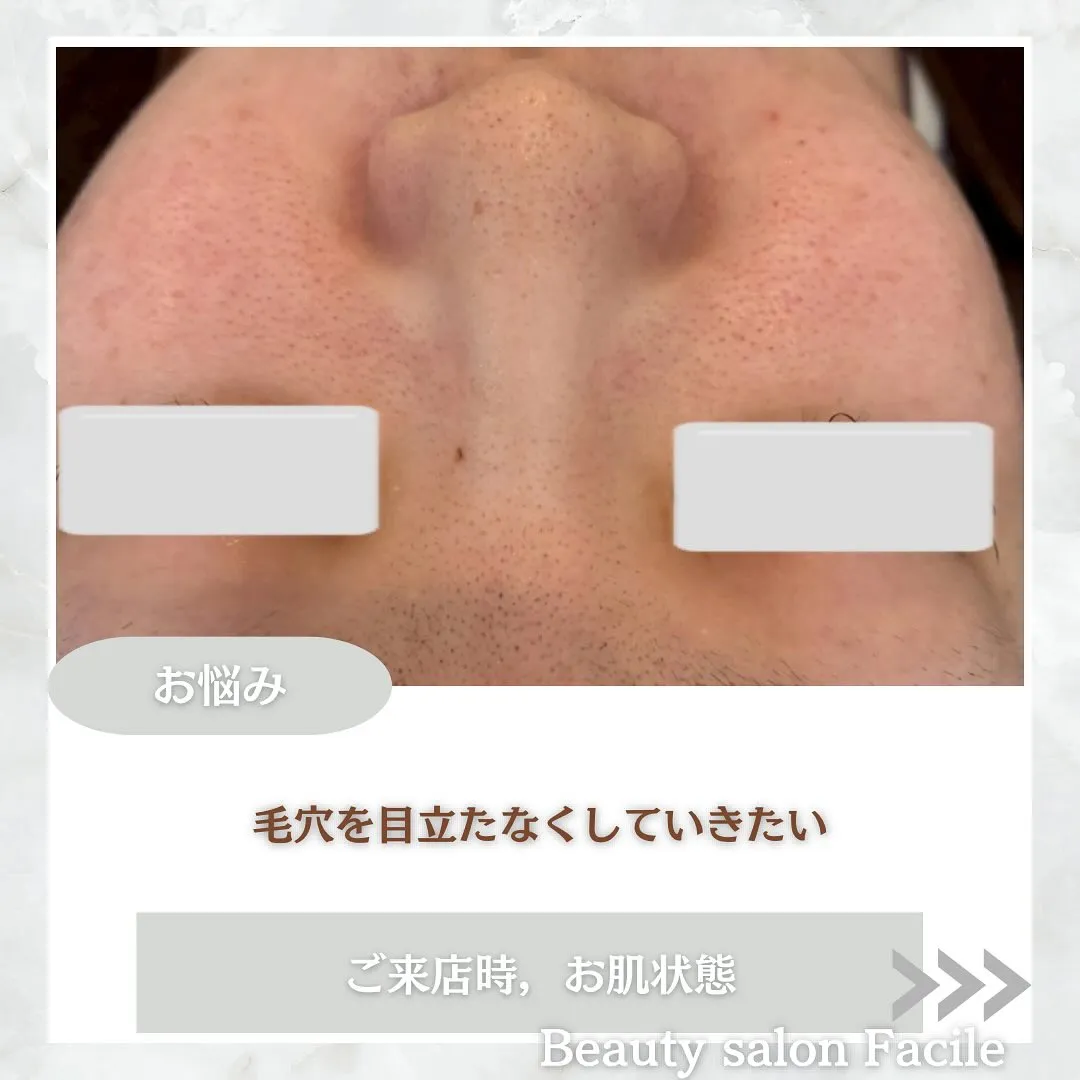 太田市にある頑固なニキビ専門店です✨️