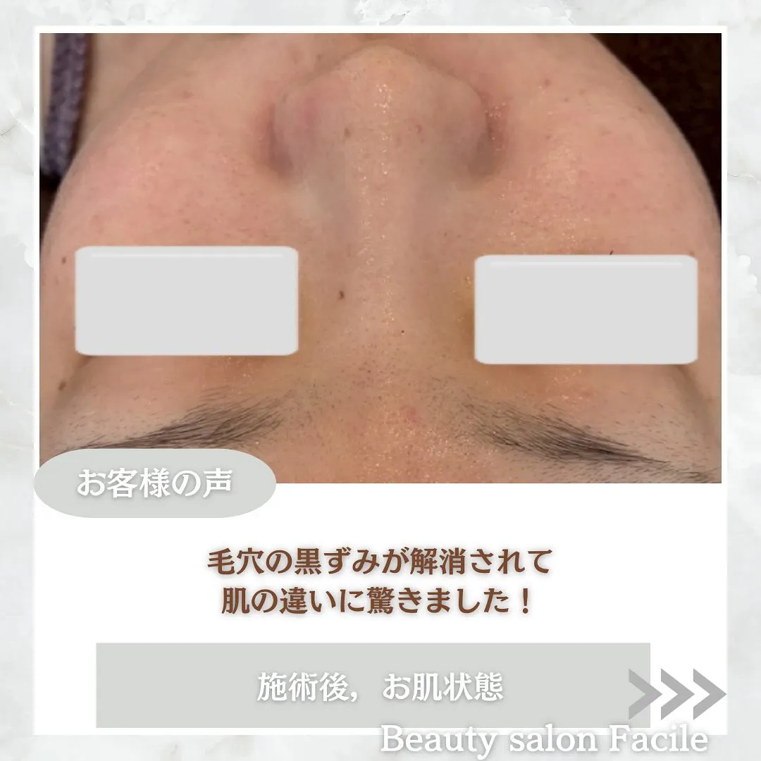 太田市にある頑固なニキビ専門店です✨️