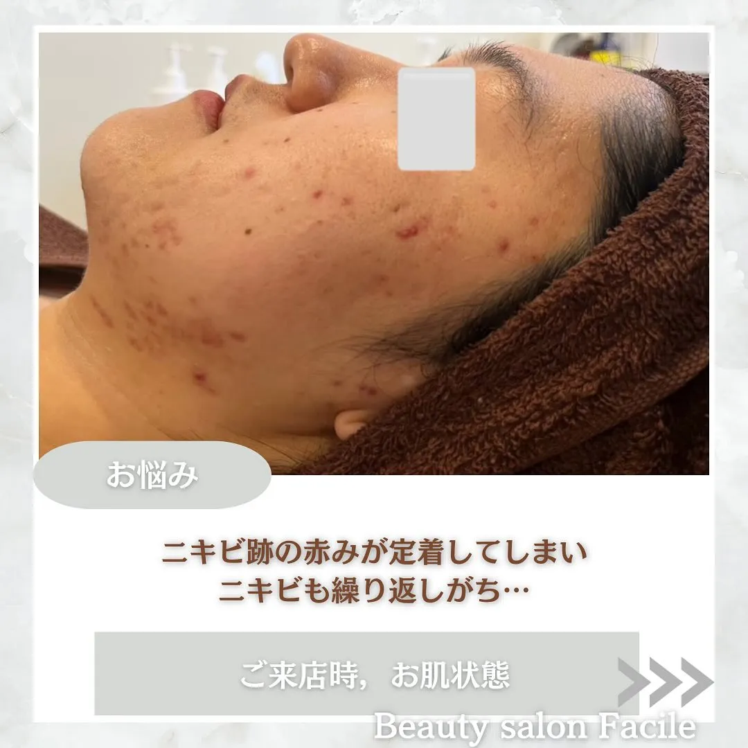 太田市にある頑固なニキビ専門店です✨️