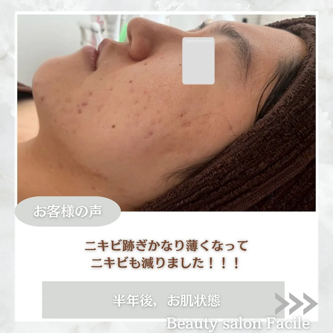 太田市にある頑固なニキビ専門店です✨️