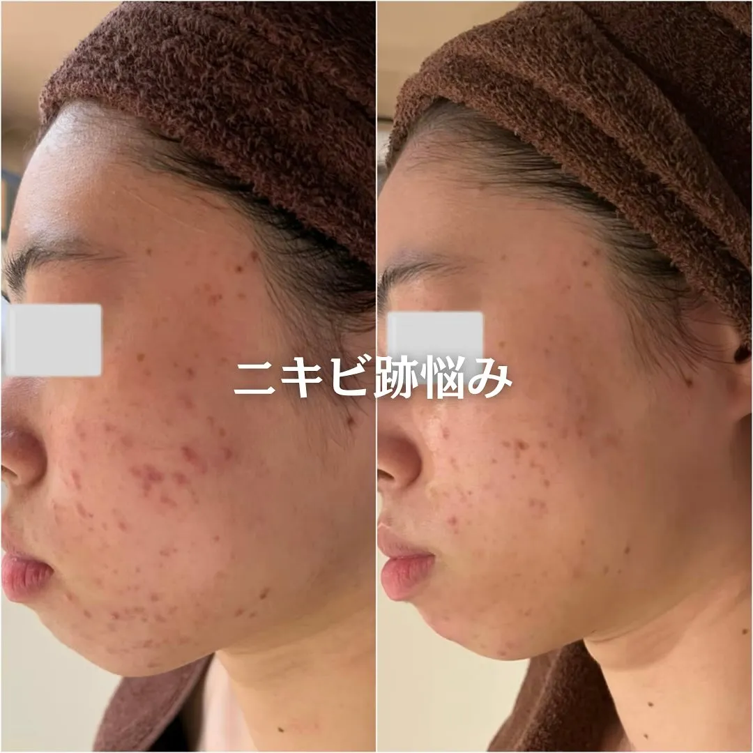 太田市にある頑固なニキビ専門店です✨️