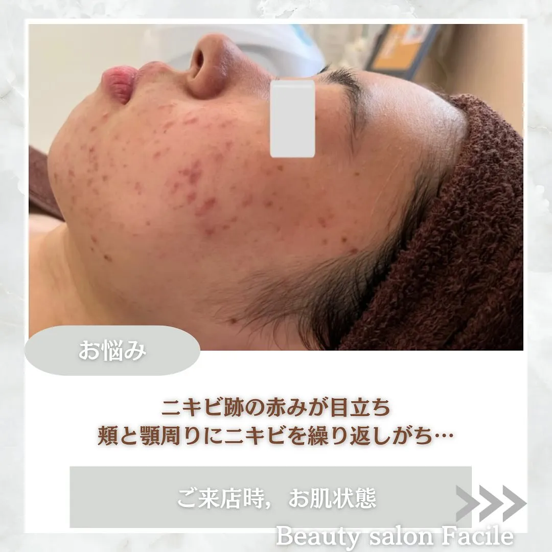 太田市にある頑固なニキビ専門店です✨️