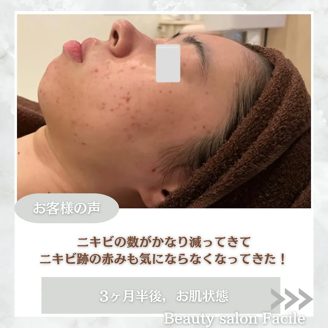 太田市にある頑固なニキビ専門店です✨️