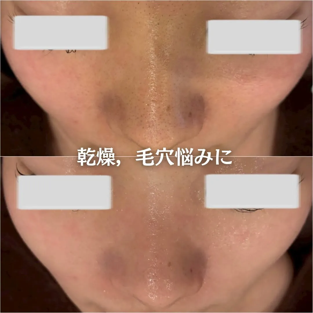 太田市にある頑固なニキビ専門店です✨️