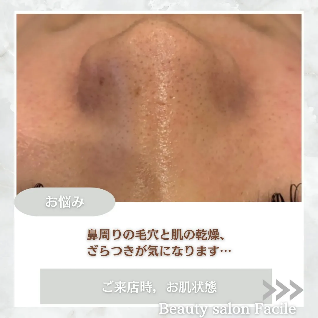 太田市にある頑固なニキビ専門店です✨️