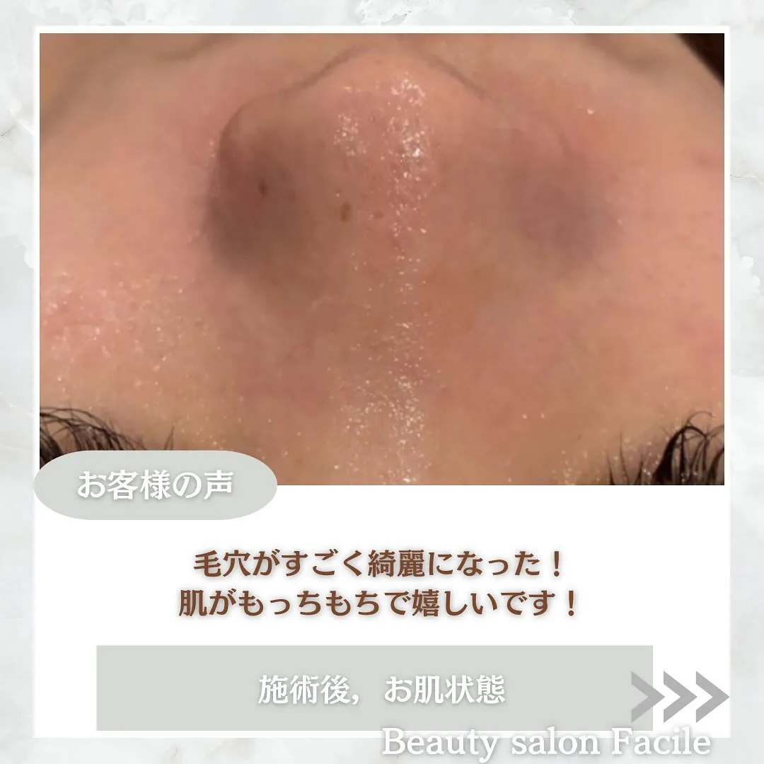 太田市にある頑固なニキビ専門店です✨️