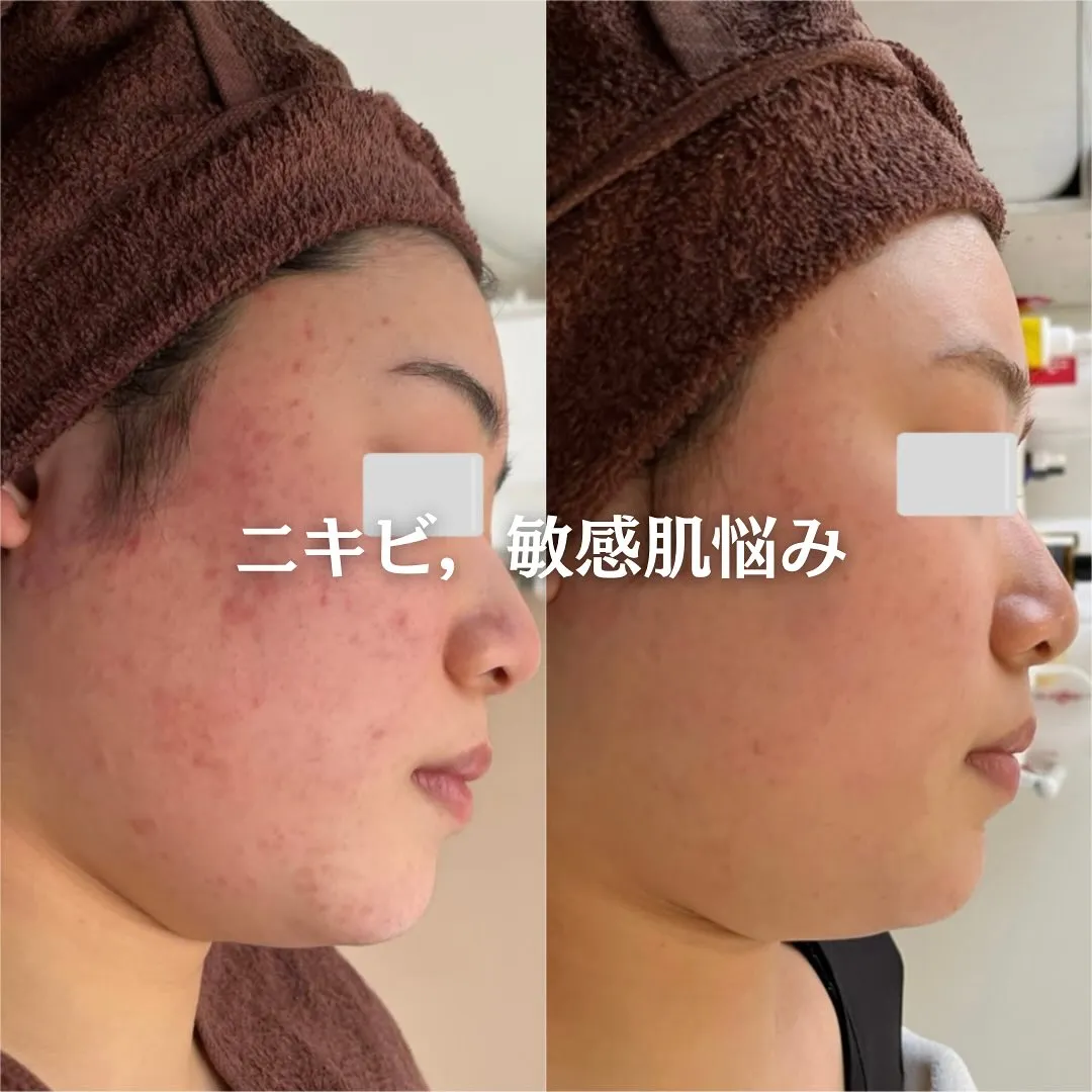 太田市にある頑固なニキビ専門店です✨️