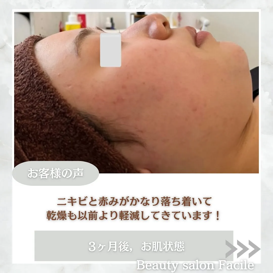 太田市にある頑固なニキビ専門店です✨️