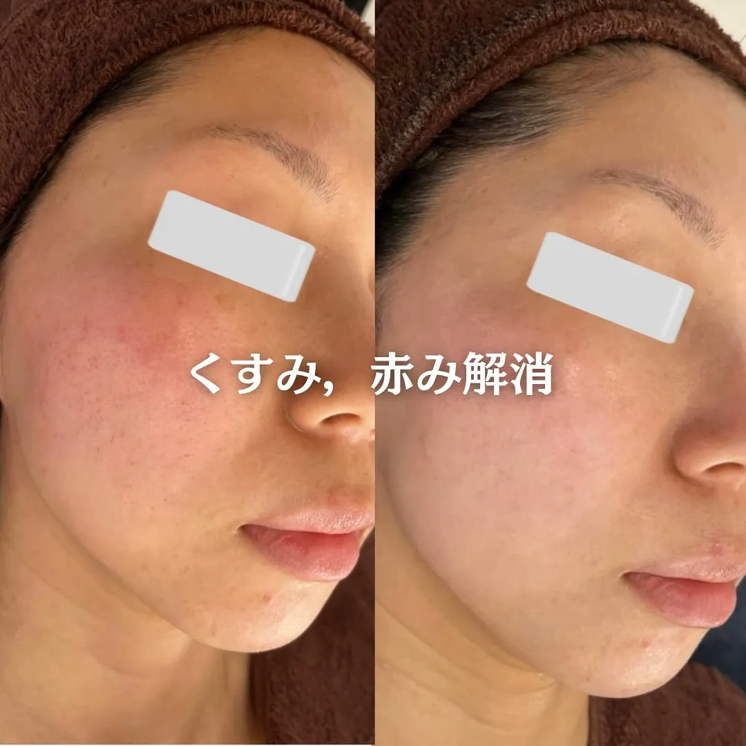 太田市にある頑固なニキビ専門店です✨️