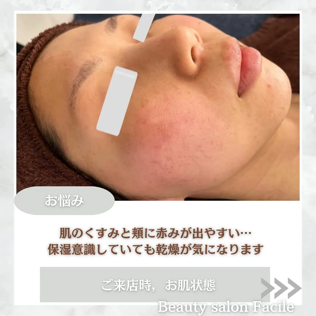 太田市にある頑固なニキビ専門店です✨️