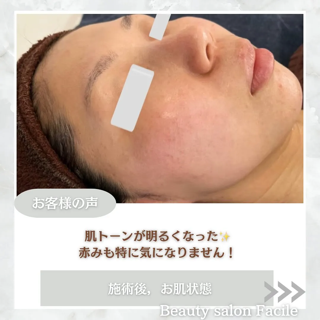 太田市にある頑固なニキビ専門店です✨️